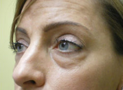 Lower Lid Blepharoplasty (lower eyelid eyelift)