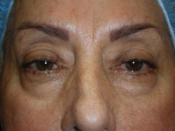 Upper Lid Blepharoplasty (upper eyelid lift)