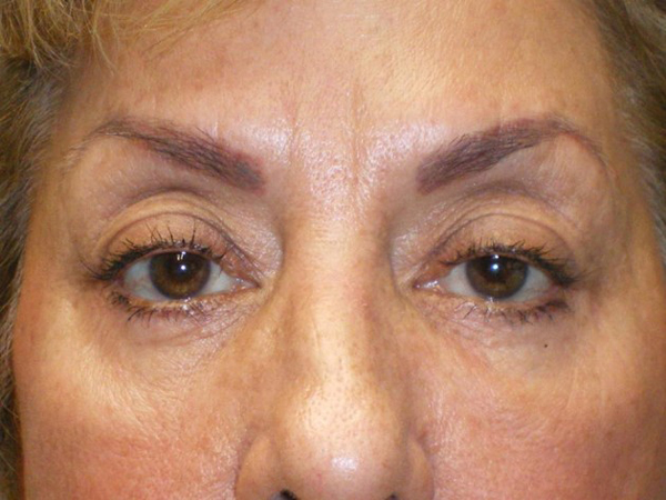 Upper Lid Blepharoplasty (upper eyelid lift)