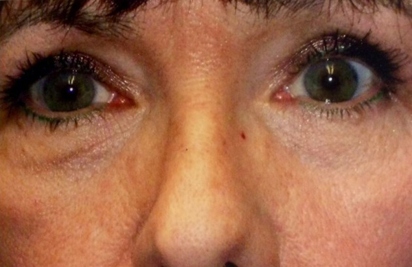 Upper Lid Blepharoplasty (upper eyelid lift)