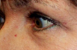 Upper Lid Blepharoplasty (upper eyelid lift)