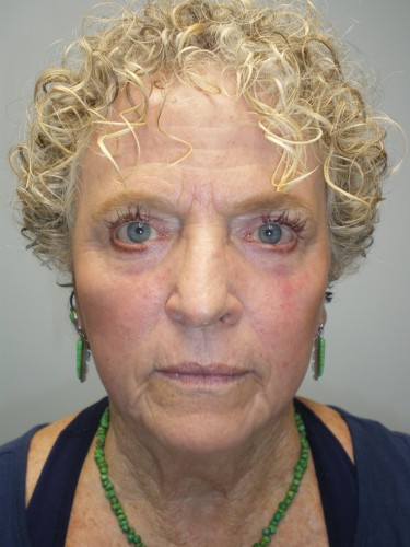 Upper Lid Blepharoplasty (upper eyelid lift)