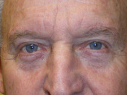 Lower Lid Blepharoplasty (lower eyelid eyelift)