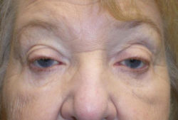 Eyelid Lift (Blepharoplasty/Ptosis Repair)