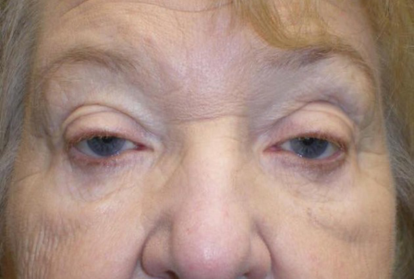 Eyelid Lift (Blepharoplasty/Ptosis Repair)