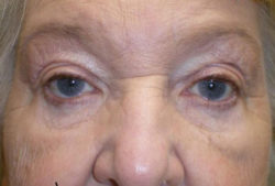Eyelid Lift (Blepharoplasty/Ptosis Repair)