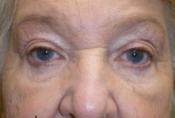 Ptosis Repair