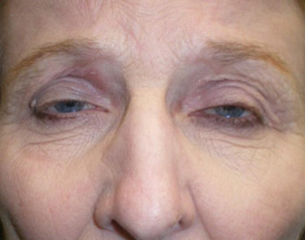 Ptosis Repair