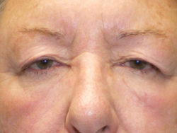 Upper Lid Blepharoplasty (upper eyelid lift)