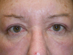 Upper Lid Blepharoplasty (upper eyelid lift)