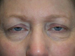 Upper Lid Blepharoplasty (upper eyelid lift)