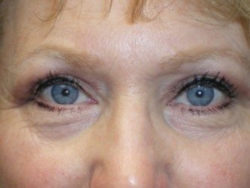 Upper Lid Blepharoplasty (upper eyelid lift)