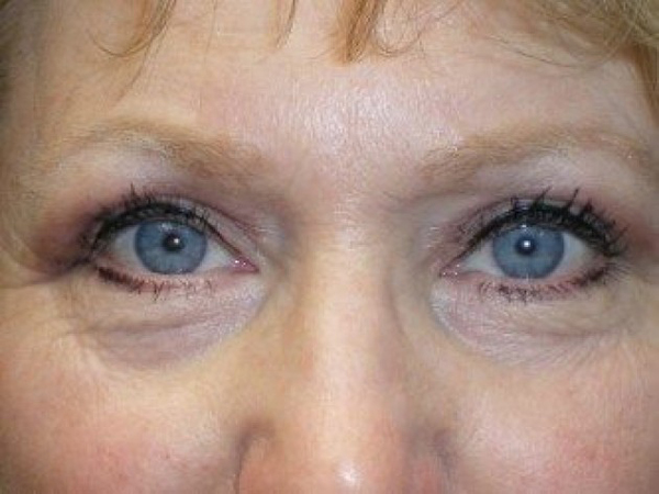 Eyelid Lift (blepharoplasty/ptosis repair)