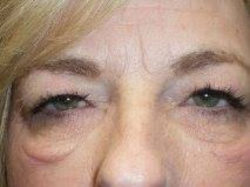 Eyelid Lift (blepharoplasty/ptosis repair)