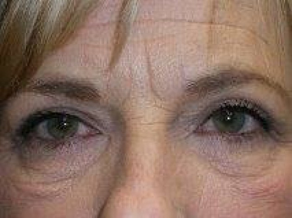 Eyelid Lift (blepharoplasty/ptosis repair)