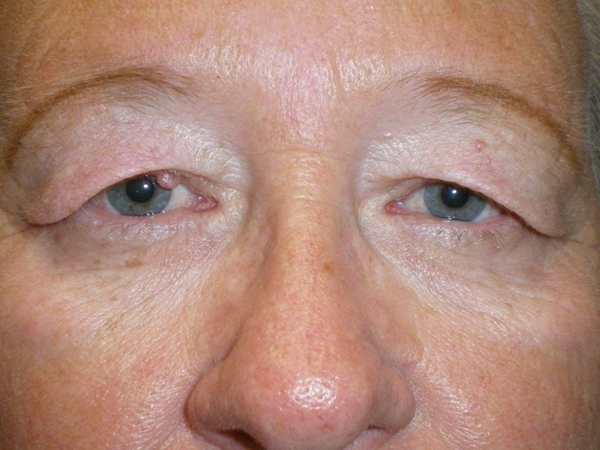 Upper Lid Blepharoplasty (upper eyelid lift)