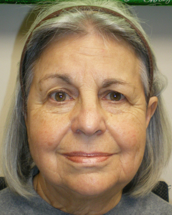 Before Brow/Forehead Lift Before Brow/Forehead Lift