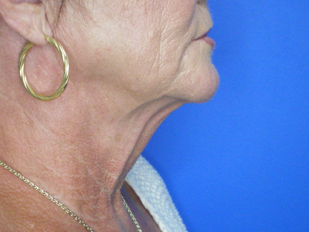 Face/Neck Lift