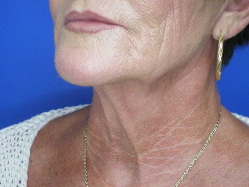 Face/Neck Lift