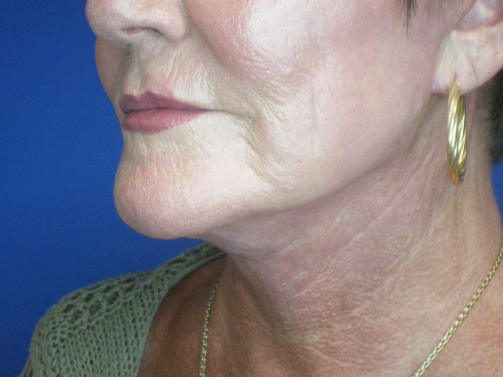 Face/Neck Lift