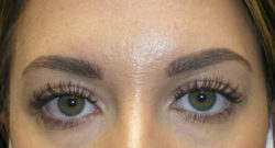 Upper Lid Blepharoplasty (upper eyelid lift)