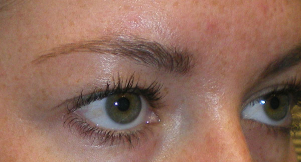 Upper Lid Blepharoplasty (upper eyelid lift)