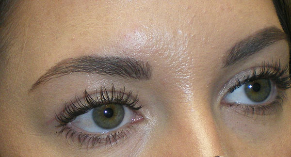 Upper Lid Blepharoplasty (upper eyelid lift)