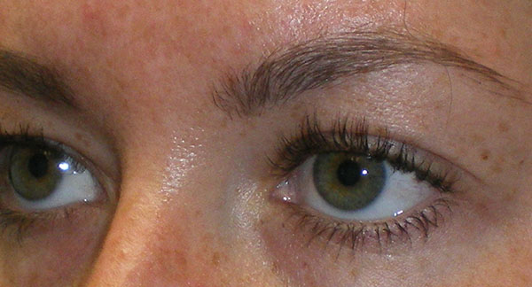 Upper Lid Blepharoplasty (upper eyelid lift)