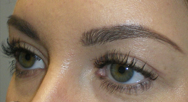 Upper Lid Blepharoplasty (upper eyelid lift)