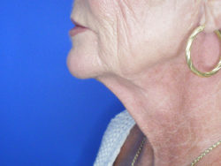 Face/Neck Lift