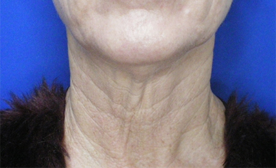 Face/Neck Lift