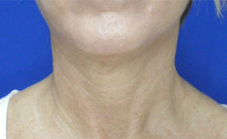 Face/Neck Lift