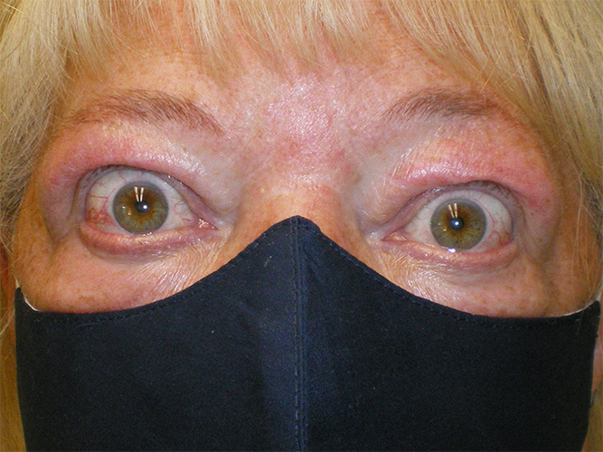 Graves’ Disease 1 Graves Disease Before and After