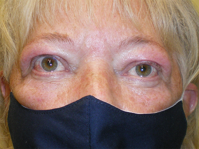 Graves’ Disease 2 Graves Disease Before and After