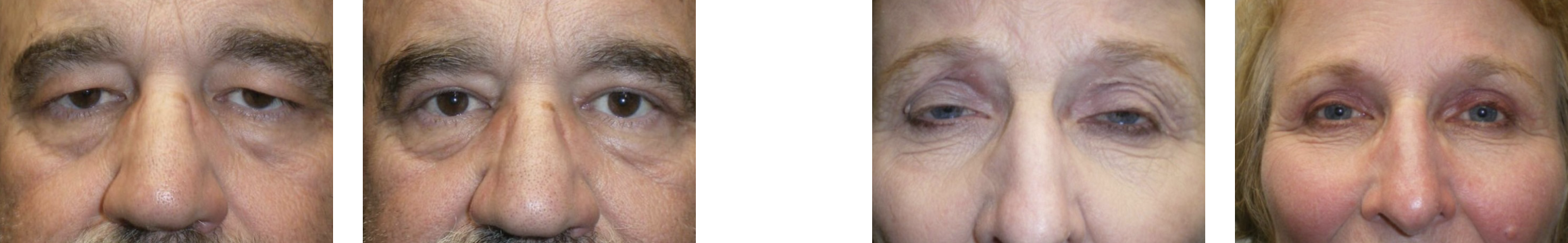Examples of functional blepharoplasty covered by insurance