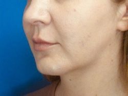 Face/Neck Lift