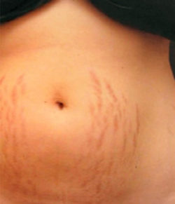 Radiofrequency Microneedling