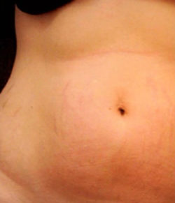 Radiofrequency Microneedling