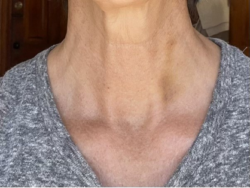 Radiofrequency Microneedling
