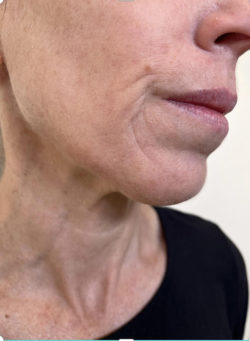 Radiofrequency Microneedling