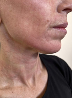 Radiofrequency Microneedling