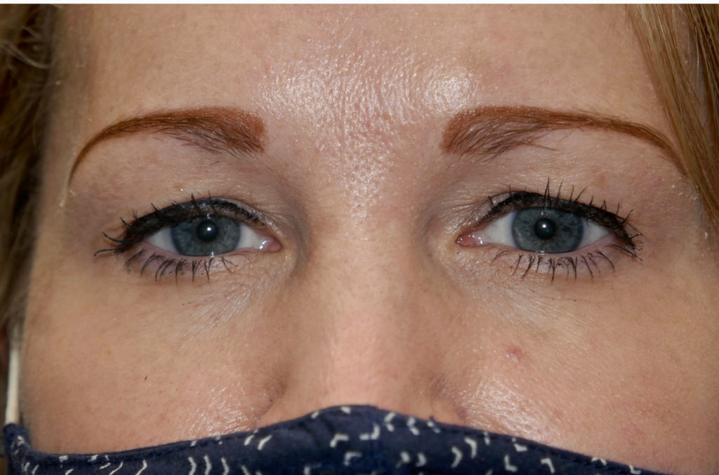 Upper Lid Blepharoplasty (upper eyelid lift)