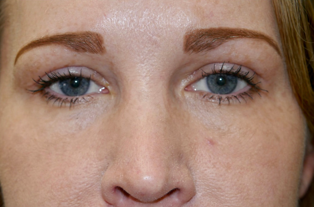 Upper Lid Blepharoplasty (upper eyelid lift)