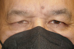 Upper Lid Blepharoplasty (upper eyelid lift)