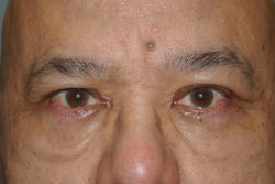 Upper Lid Blepharoplasty (upper eyelid lift)