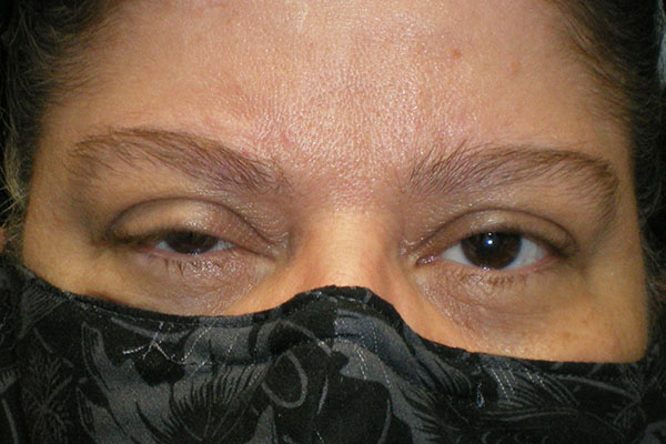 Eyelid Lift (blepharoplasty/ptosis repair)