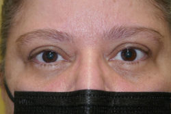 Eyelid Lift (blepharoplasty/ptosis repair)