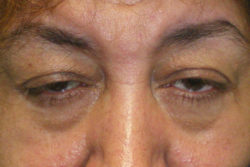 Eyelid Lift (blepharoplasty/ptosis repair)