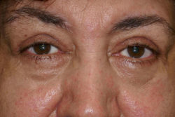 Eyelid Lift (blepharoplasty/ptosis repair)