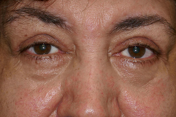 Eyelid Lift (blepharoplasty/ptosis repair)